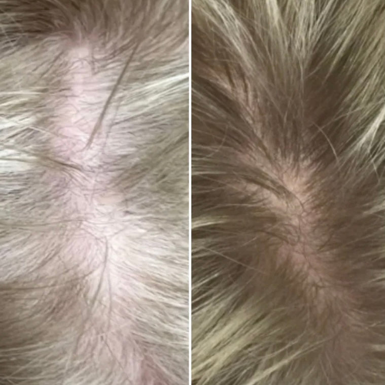 Calecim Professional Advanced Hair System