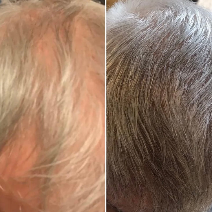 Calecim Professional Advanced Hair System