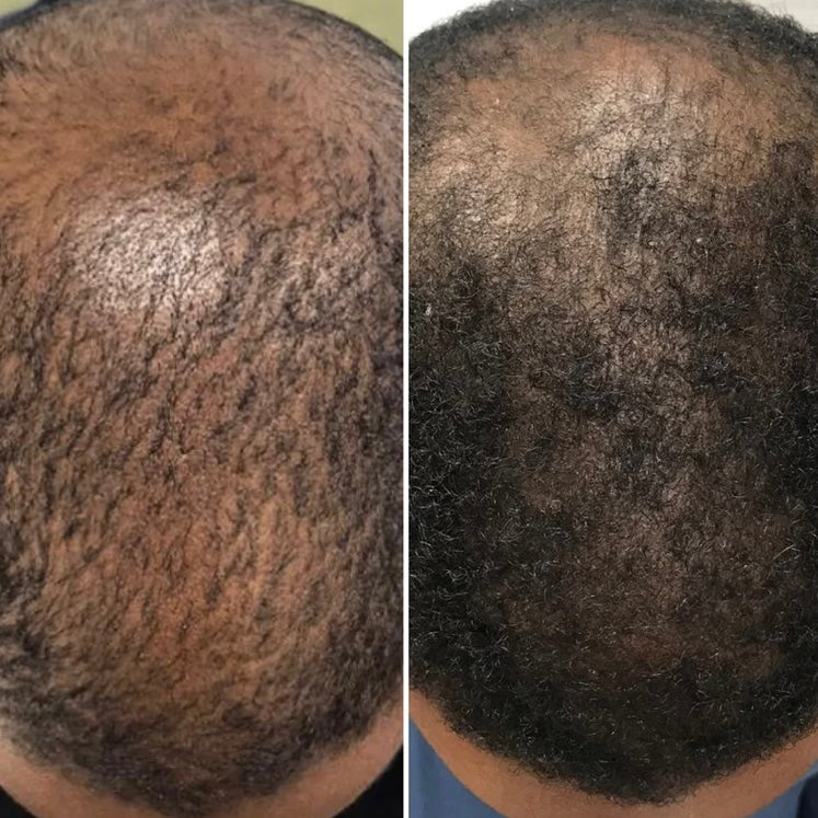 Calecim Professional Advanced Hair System